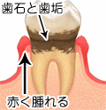 初期歯周炎